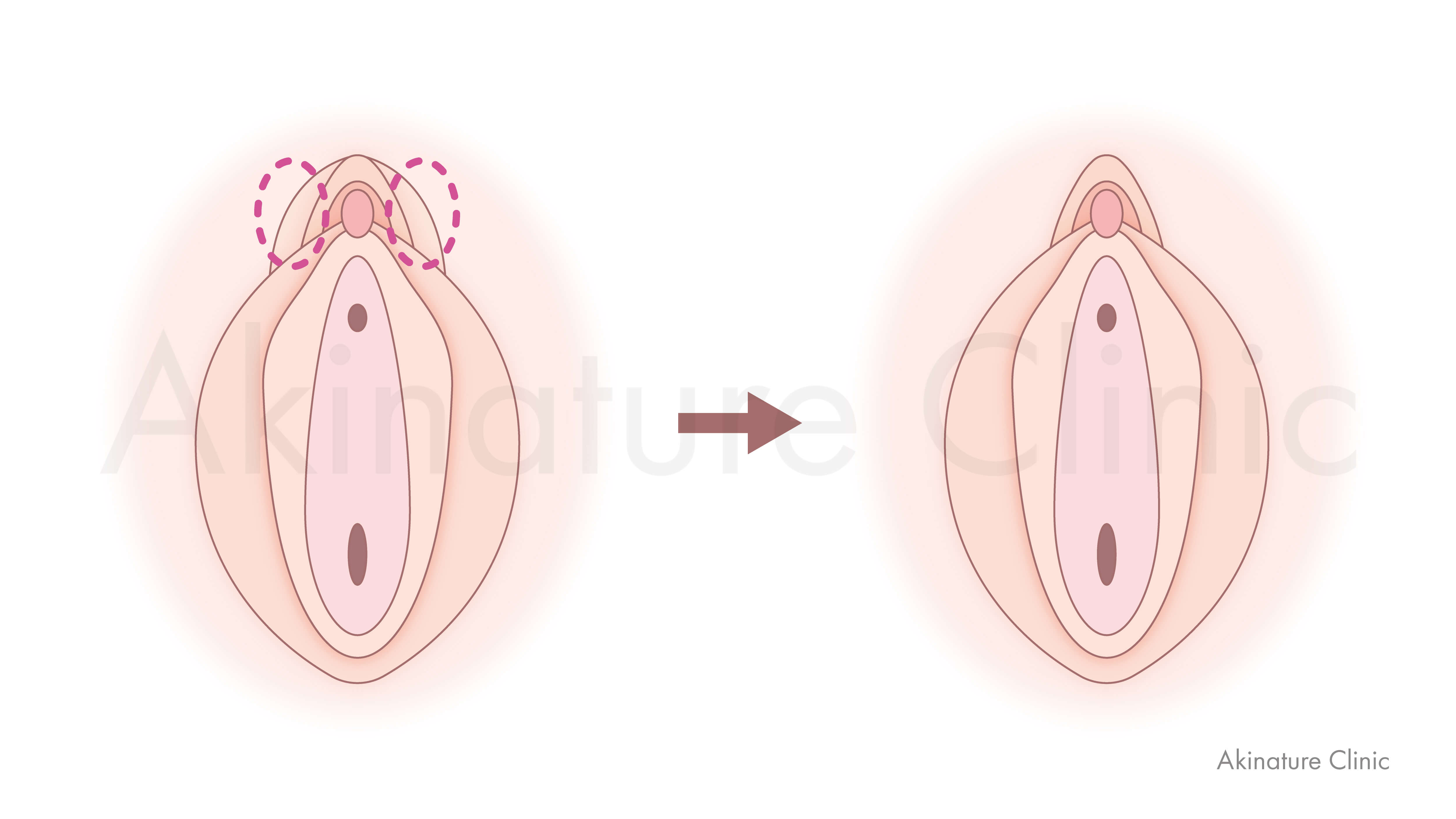 副皮除去術