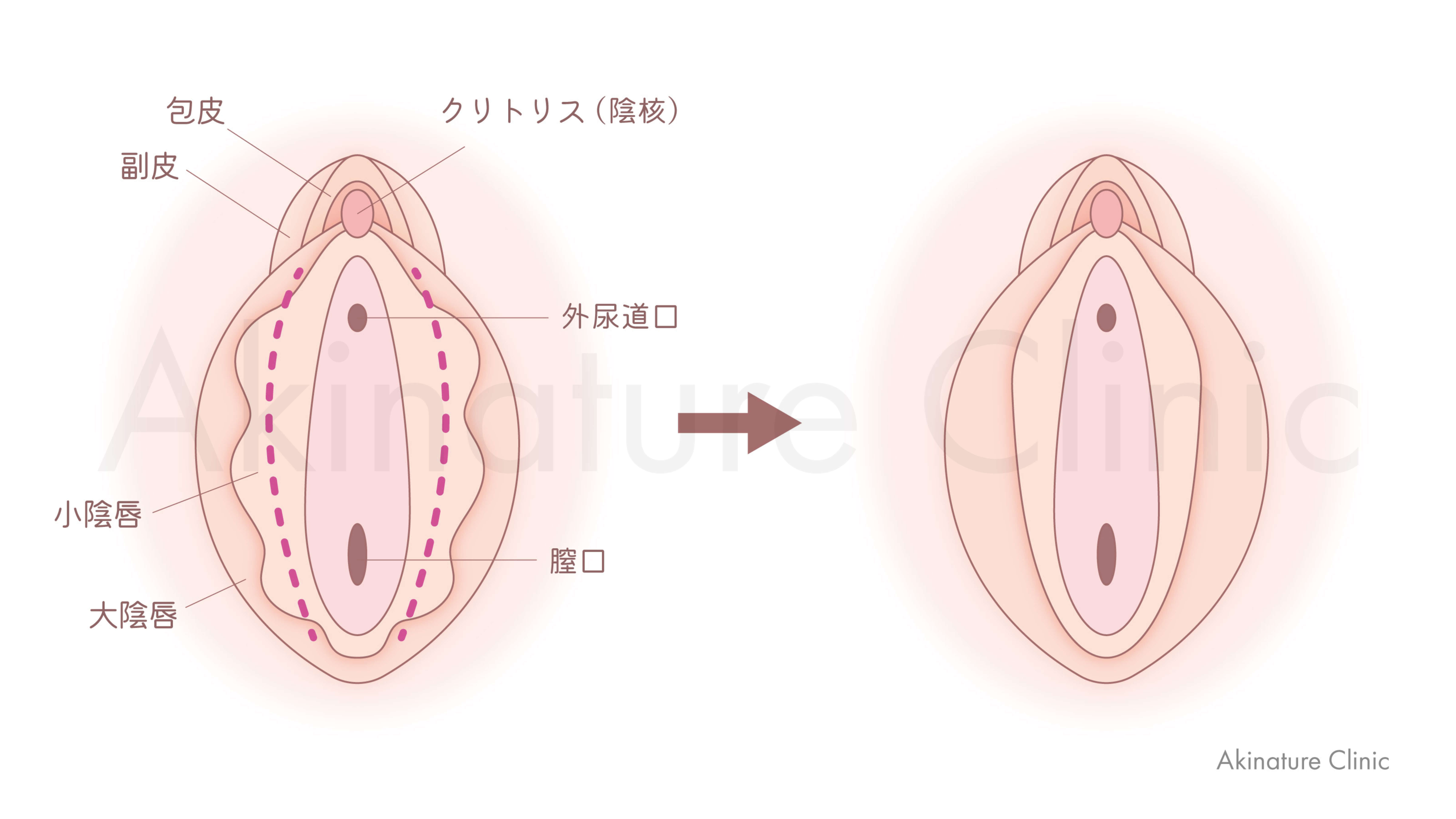 小陰唇縮小術
